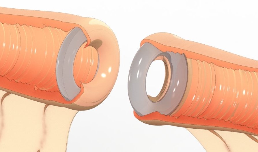 Plio Surgical Ireland